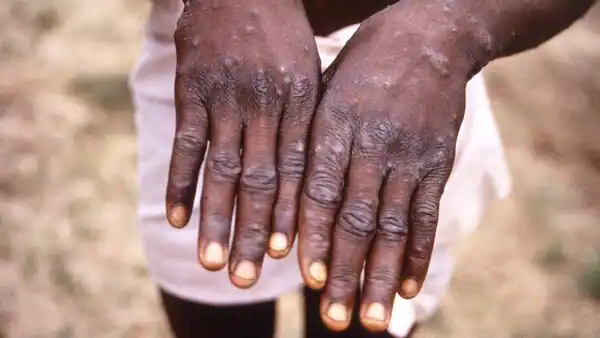Monkeypox outbreak: Centre advises isolation of suspected cases. See details here